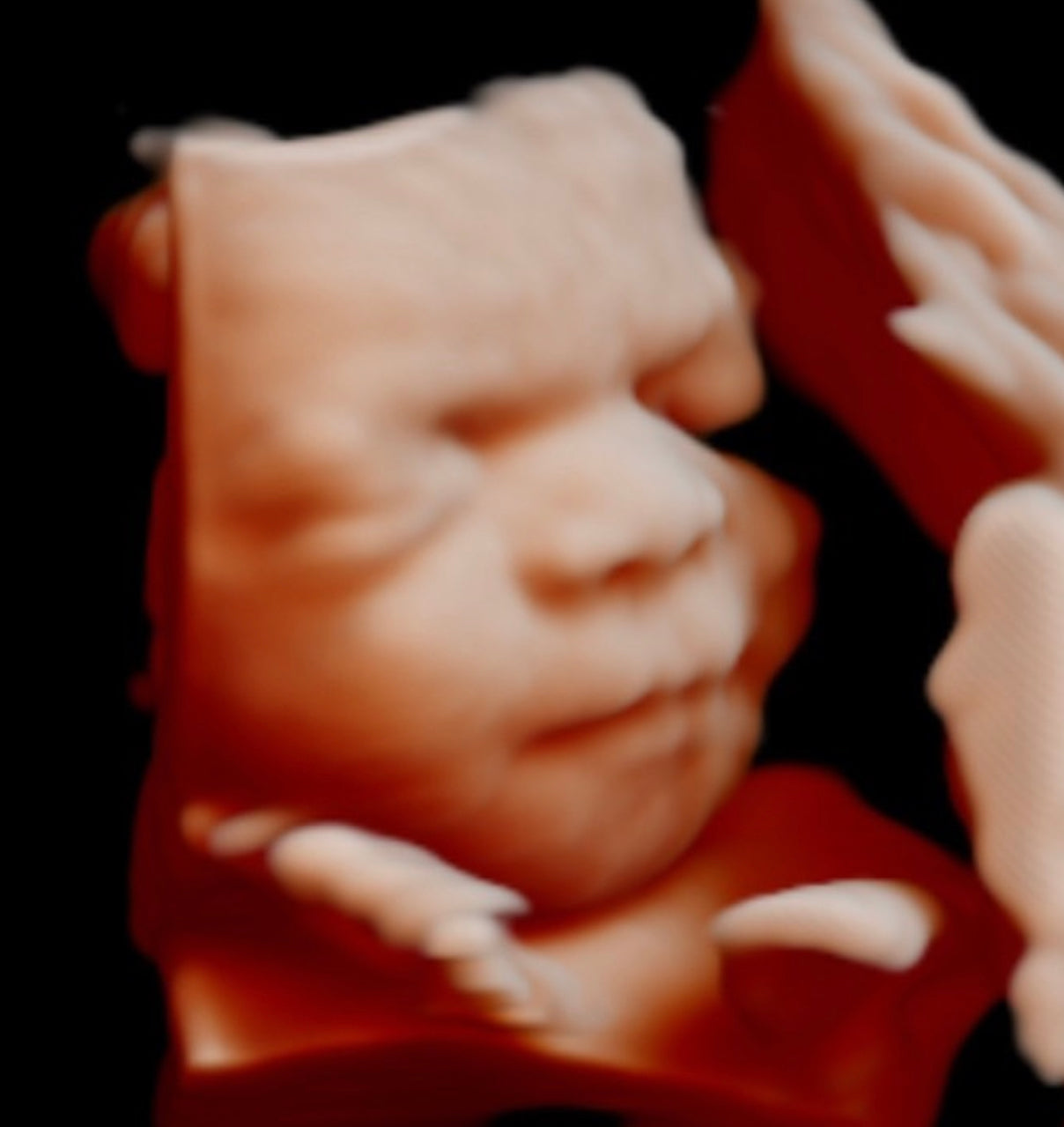 HD Live Ultrasound baby gender