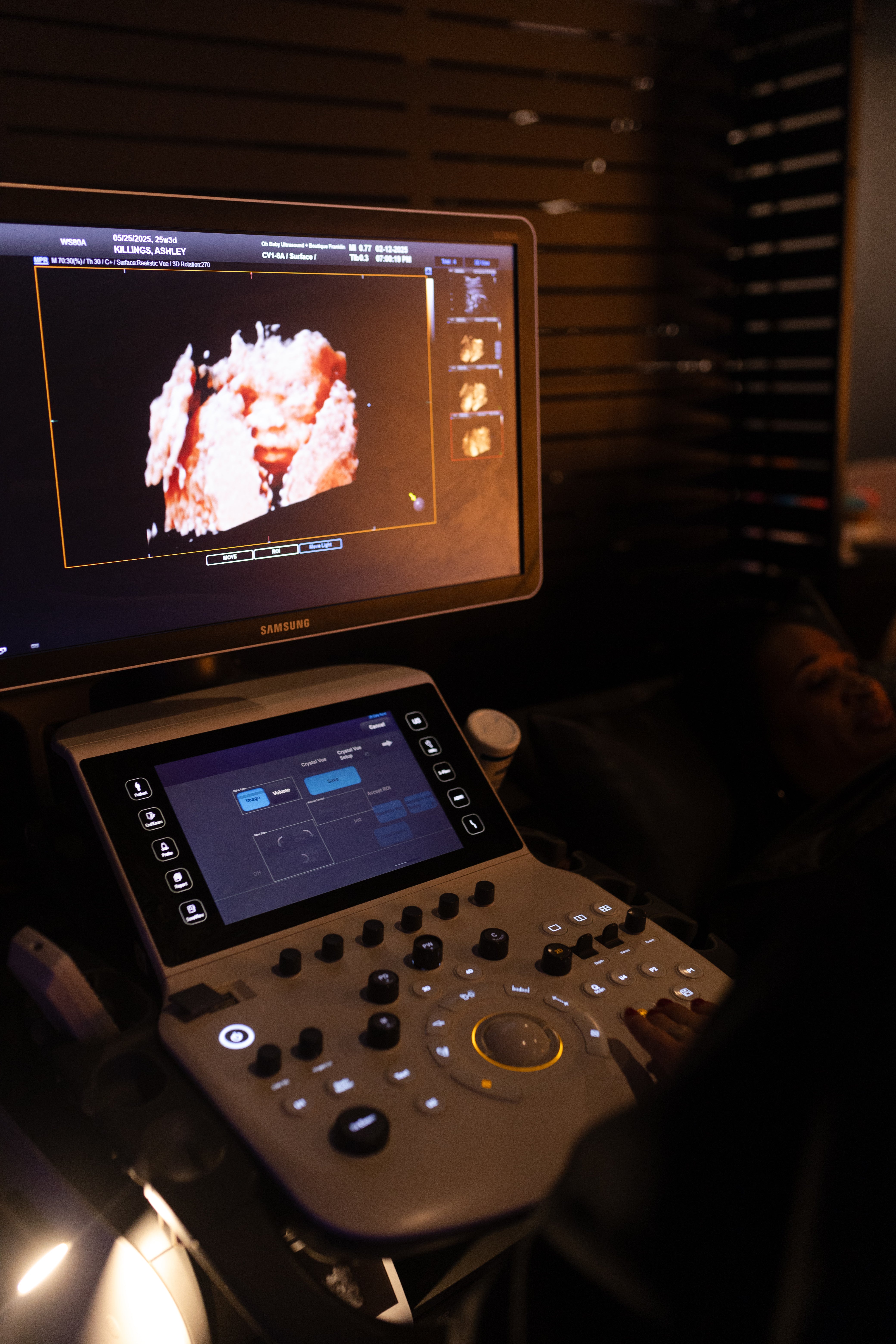 The difference between 3D, 4D and HD ultrasound explained