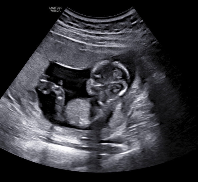 2D Ultrasound